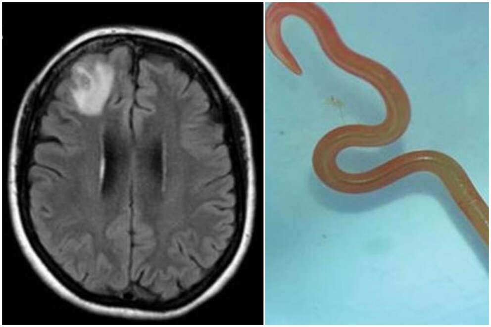 Foto tratte dall’articolo “Human Neural Larva Migrans Caused by Ophidascaris robertsi Ascarid” per “Emerging Infectious Diseases
