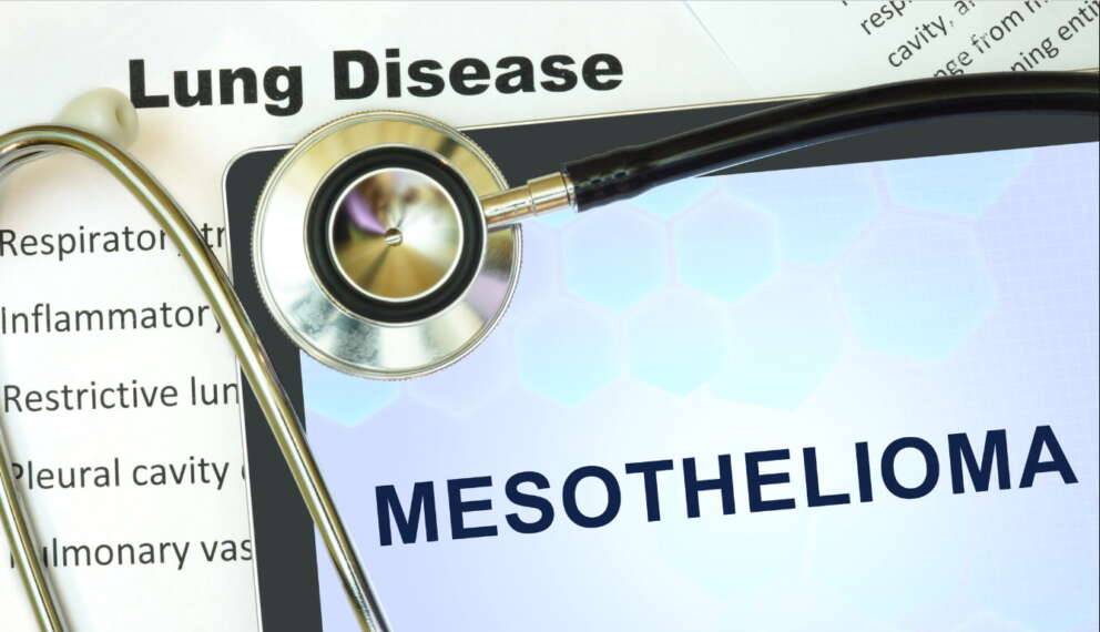 Mesotelioma: cos’è il tumore dell’amianto. Cause, sintomi e possibilità di sopravvivenza